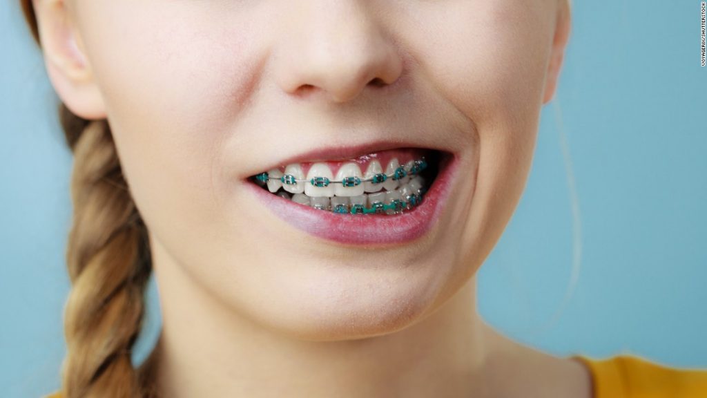 Selalu Tercabut Bracket Ketika Memakai Braces? Kenapa dan Apakah Tips