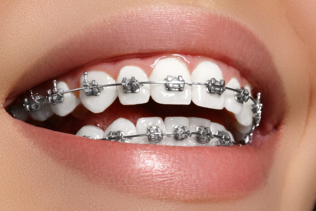 Selalu Tercabut Bracket Ketika Memakai Braces? Kenapa dan Apakah Tips
